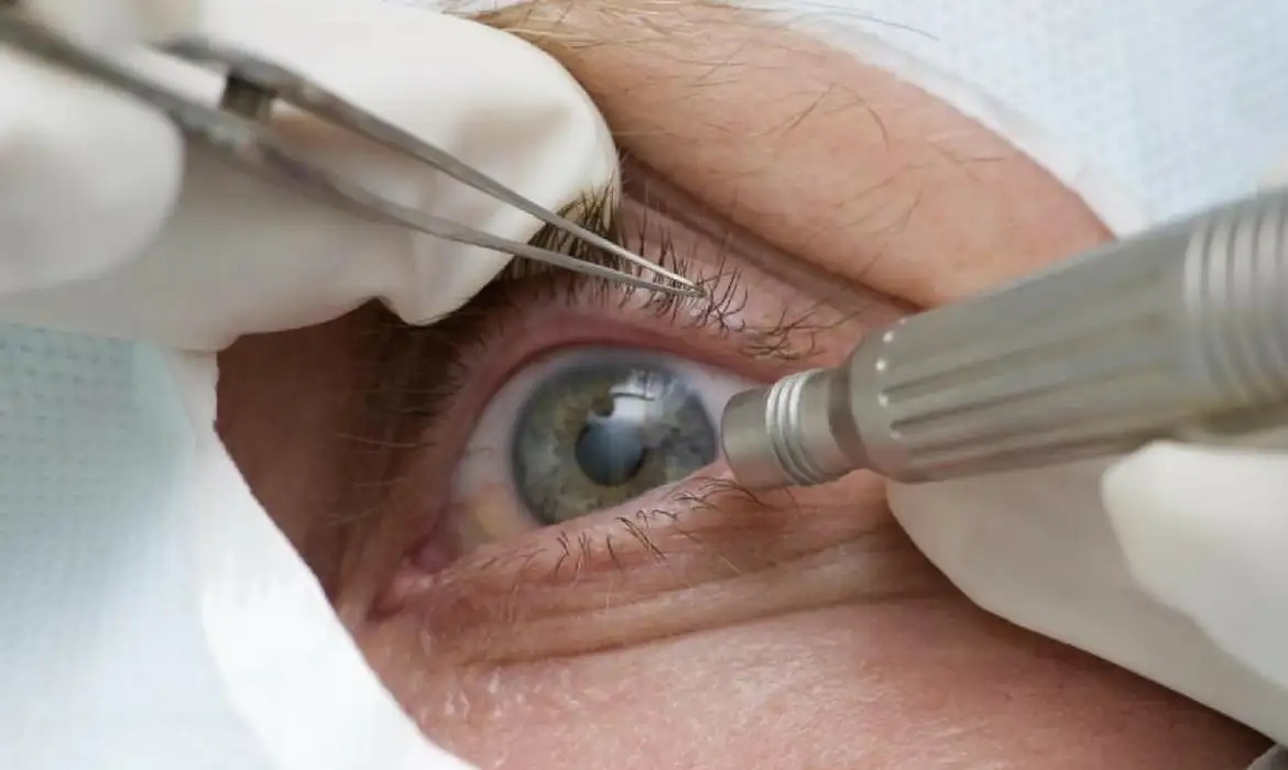 Médicos alertam para riscos de cirurgia de mudança da cor dos olhos.