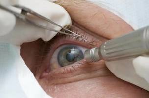 Médicos alertam para riscos de cirurgia de mudança da cor dos olhos. (Foto: Pref de Três Barras SC/Divulgação/Direitos Reservados)