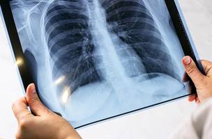 Mulher morre por tuberculose em Picos; cidade já registra seis óbitos em 2026. (Foto: Divulgação/ Ascom)