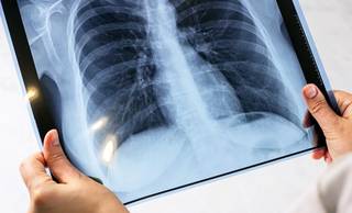 Mulher morre por tuberculose em Picos; cidade já registra seis óbitos em 2026 Mulher morre por tuberculose em Picos; cidade já registra seis óbitos em 2026